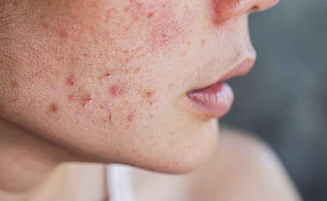 Acne Care: गर्मियों में एक्ने से परेशान हैं? तो इन स्किन केयर टिप्स को अपनाओ!