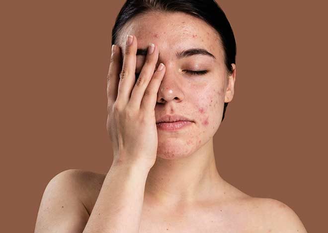 Skin Health: स्ट्रेस चेहरे का निखार छीन सकता है! दाग-धब्बे और पिंपल्स का जोखिम बढ़ाता हैं, वक्त रहते हुए सावधान रहें