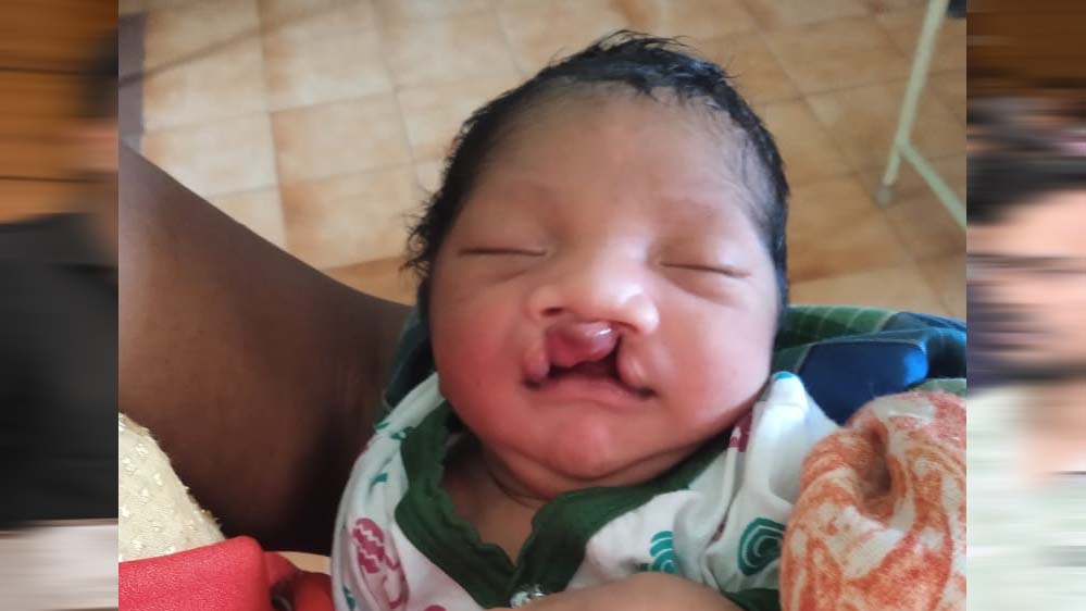 चिरायु टीम ने दिया एक परिवार को नया जीवन, जन्मजात विकृति से जूझ रहे बच्चे को मिली राहत चिरायु टीम की मदद से एक बच्चे को मिला नया जीवन, जन्मजात विकृति से जूझते परिवार की उम्मीद जगी