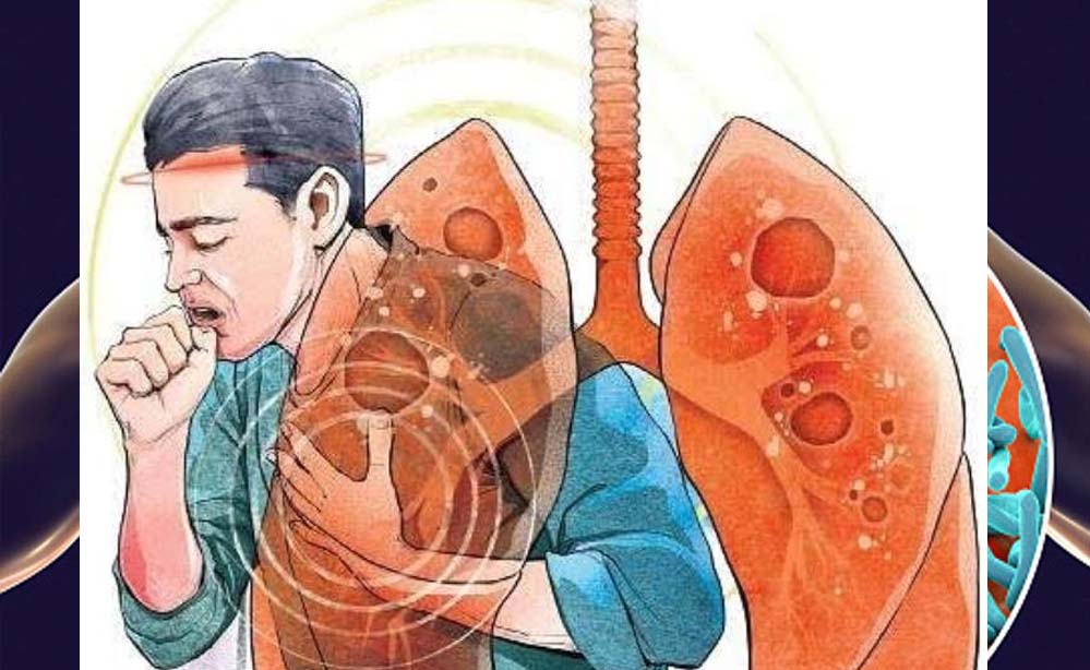 चंडीगढ़ में टीबी के मामलों में इजाफा, रोज़ 18 नए मामले, 6000 लोग प्रभावित