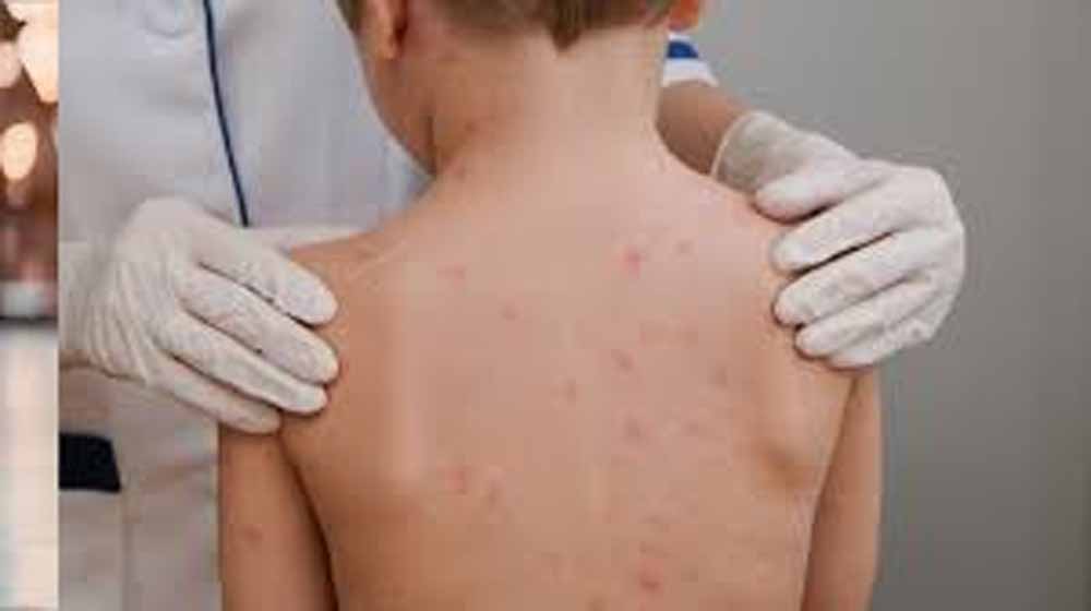 मध्य प्रदेश में खसरे का खतरा बढ़ा, 4 जिलों में 12 केस मिले; घर-घर सर्वे शुरू