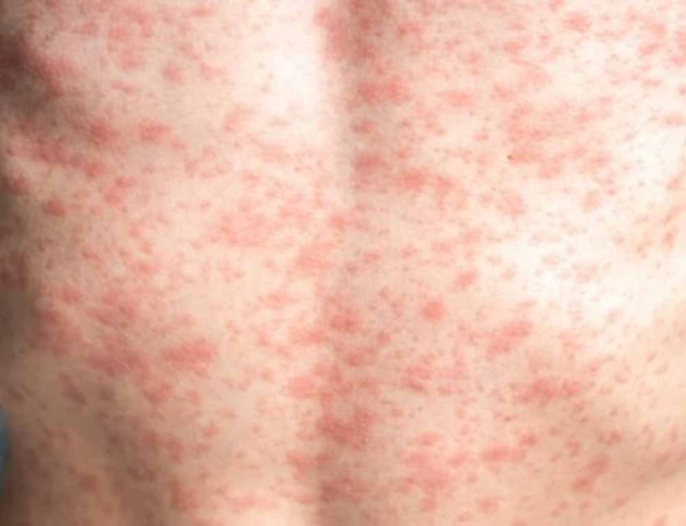 खसरे की चपेट में रतलाम के बच्चे, तुरंत कार्रवाई में जुटी स्वास्थ्य टीम