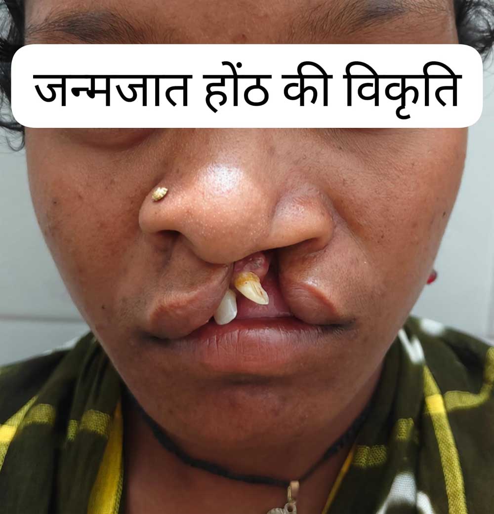जन्मजात होंठ की विकृति का हुआ सफल उपचार, अब सामान्य जीवन जी रही हैं 22 वर्षीय युवती